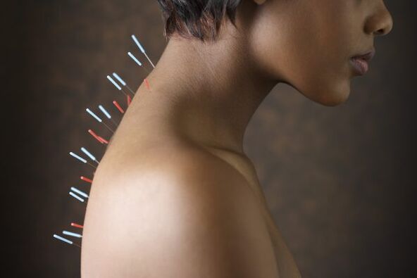 akupunktúra a hátfájás ellen