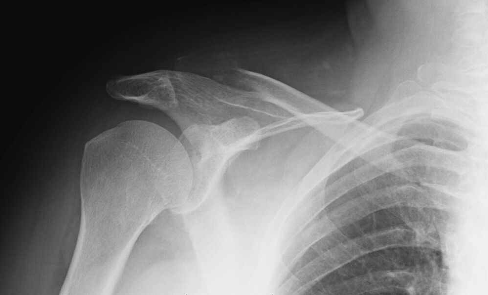váll arthrosis röntgen