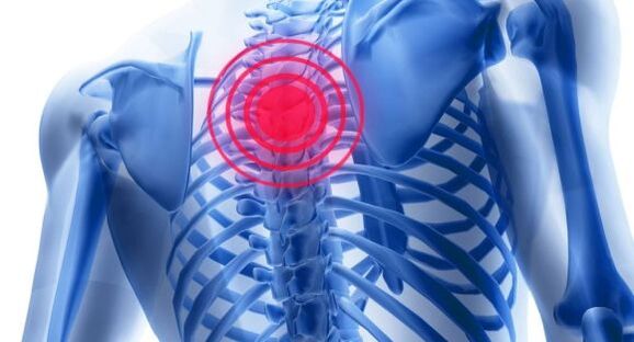 A mellkasi gerinc osteochondrosis kezelése