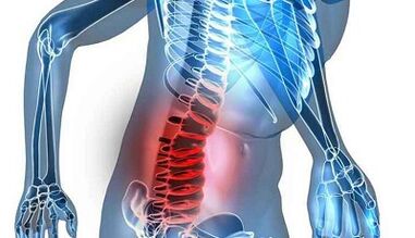 Az ágyéki osteochondrosis jelei és tünetei