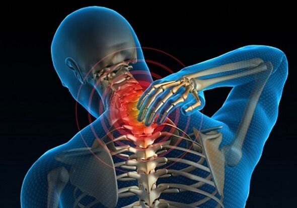 nyaki fájdalom osteochondrosis miatt
