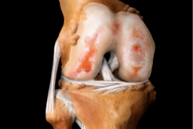 a térdízület károsodása arthrosis miatt